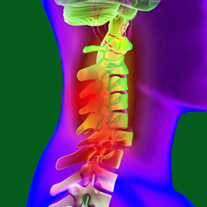 Spondylolisthesis Spinal Cord Injury